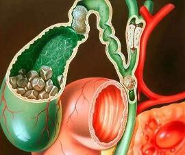 結(jié)石性膽囊炎