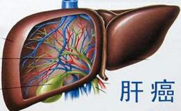 肝癌
