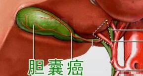 膽囊癌