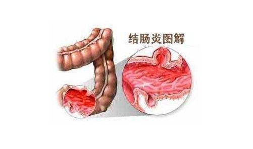 結(jié)腸炎