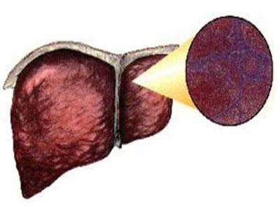 原發(fā)性膽汁性肝硬化