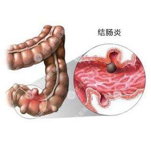 慢性結(jié)腸炎