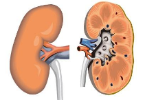 慢性腎功能衰竭