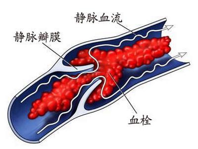 門靜脈血栓形成