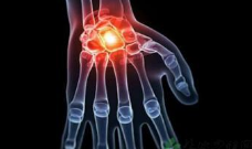 類風(fēng)濕性關(guān)節(jié)炎