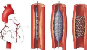 冠狀動(dòng)脈介入術(shù)
