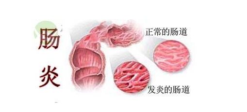 急性腸炎