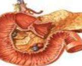 良性十二指腸淤滯癥