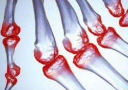 風濕性關(guān)節(jié)炎