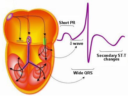 預(yù)激綜合征