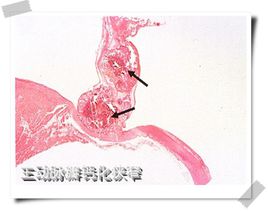 主動(dòng)脈瓣鈣化