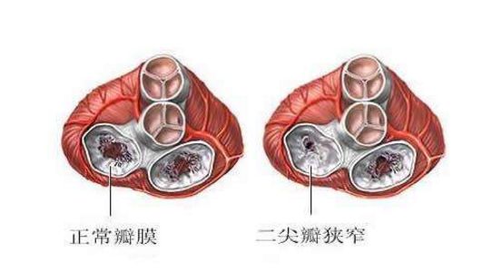 二尖瓣狹窄