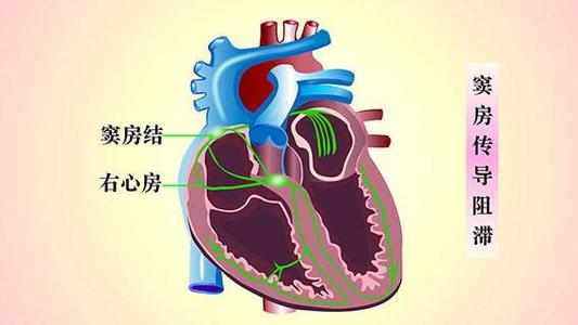 房室傳導(dǎo)阻滯