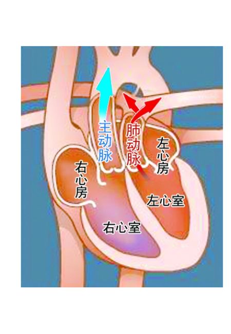 完全性大動(dòng)脈轉(zhuǎn)位
