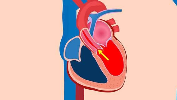 肺動(dòng)脈瓣狹窄