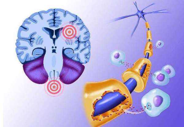 多發(fā)性硬化