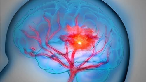 蛛網(wǎng)膜下腔出血