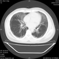 肺泡蛋白質(zhì)沉積癥