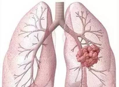 肺結(jié)核