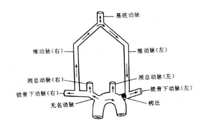 椎-基底動(dòng)脈盜血綜合征