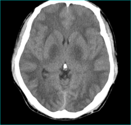腦白質(zhì)脫髓鞘