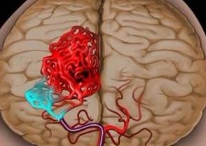 顱內(nèi)靜脈竇血栓