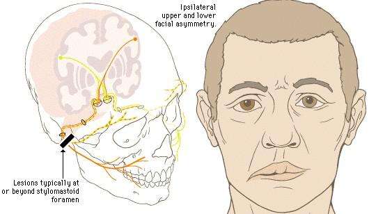 腓總神經(jīng)麻痹