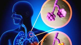 支氣管結(jié)核