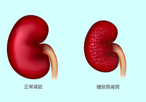 糖尿病腎病
