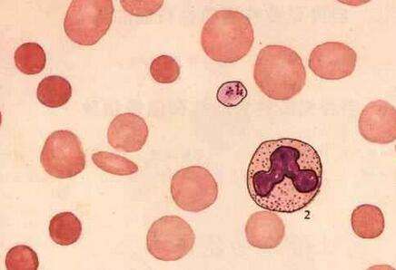 自身免疫性溶血性貧血