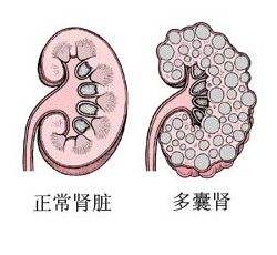 多囊腎