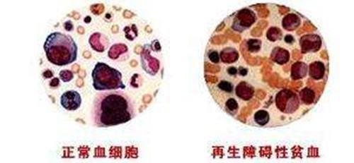 再生障礙性貧血