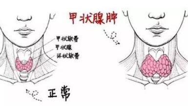 單純性甲狀腺腫