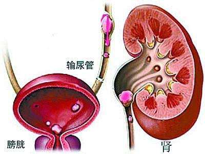 重復(fù)腎盂輸尿管畸形