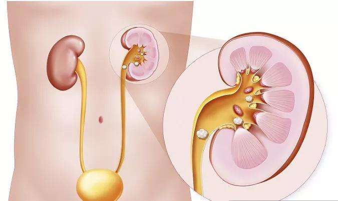 繼發(fā)性腎臟疾病