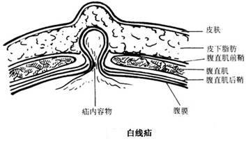 白線(xiàn)疝