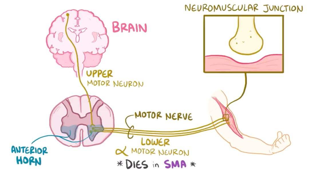脊髓性肌肉萎縮