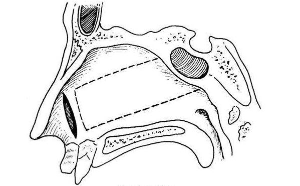 上頜竇牙源性囊腫