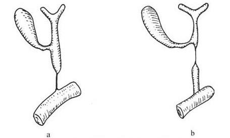 先天性膽道閉鎖