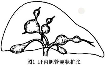 先天性膽管擴(kuò)張癥