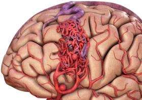 顱內(nèi)動(dòng)靜脈畸形