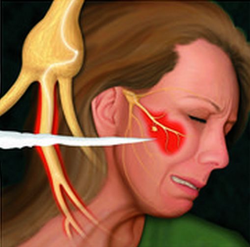 三叉神經(jīng)痛