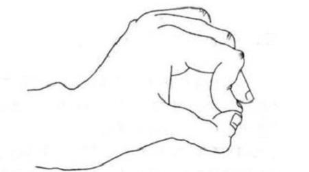 尺神經(jīng)損傷