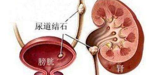 尿結(jié)石