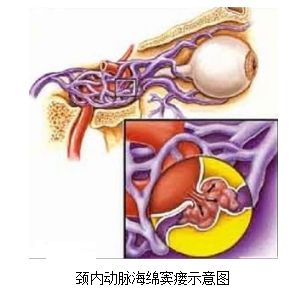 頸動(dòng)脈海綿竇瘺
