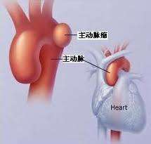 胸主動脈瘤
