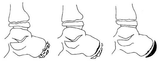 股骨頭骨骺骨軟骨病