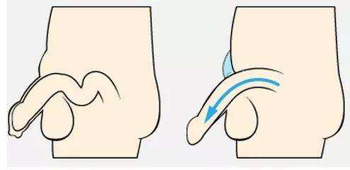 陰莖延長(zhǎng)