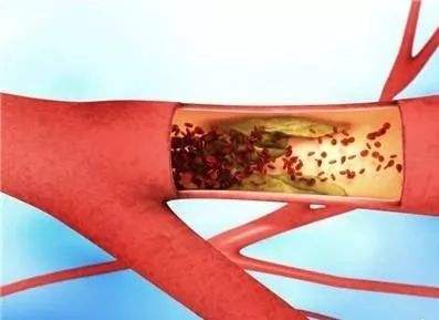 結(jié)節(jié)性多動脈炎