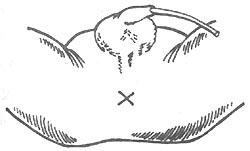 先天性肛門閉鎖